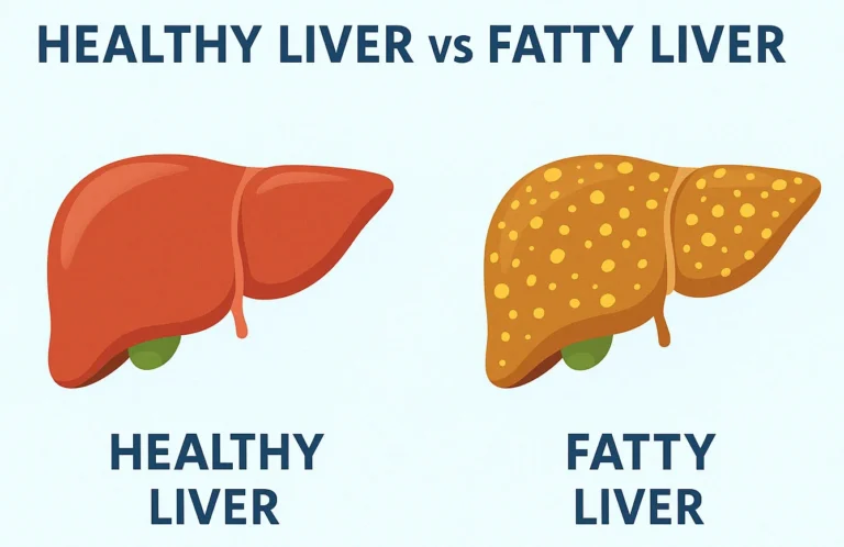 Comparison image showing a healthy liver versus a fatty liver – visual guide to NAFLD condition